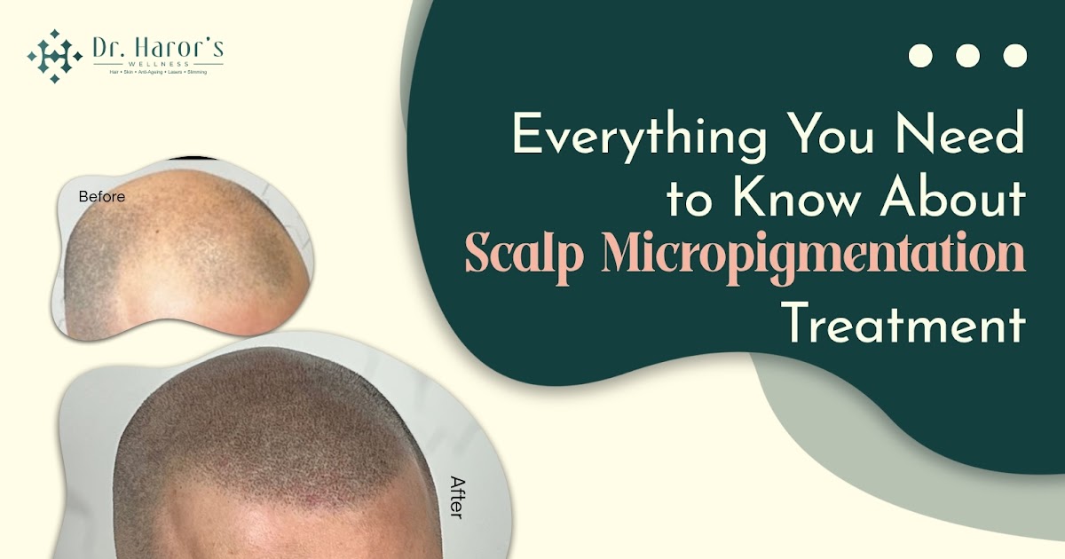 Everything You Need to Know About Scalp Micropigmentation Treatment