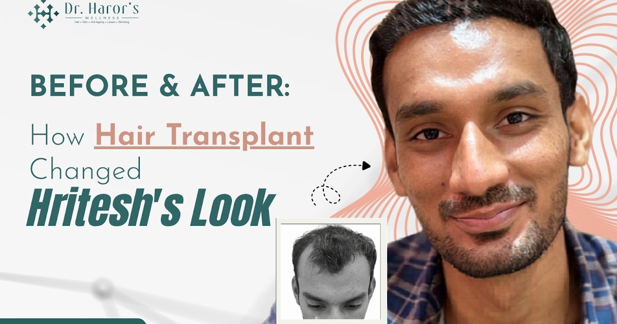 Before & After: How Hair Transplant Changed Hritesh's Look